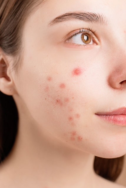 Acne behandelen